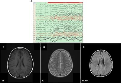 Case report: A novel mosaic nonsense mutation of PCDH19 in a Chinese male with febrile epilepsy